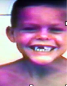 A smiling child with missing front teeth.